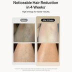 Professional IPL Laser Hair Removal home salon device